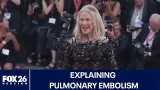 Explaining pulmonary embolism: Catherine O'Hara's cause of death