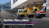 Ausstellung in Dresdner Uniklinik zeigt Folgen von Verbrennungen | Sachsen Fernsehen