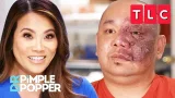 Port-Wine Stains and Other Birthmarks | Dr. Pimple Popper | TLC Port-Wine Stains and Other Birthmarks | Dr. Pimple Popper | TLC